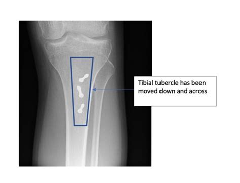 Tibial Tubercle Osteotomy Knee Cap Surgeon London Expert Knee Clinic