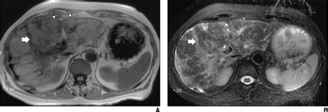 Figure 1 from CT and MRI of cirrhosis and its mimics. | Semantic Scholar