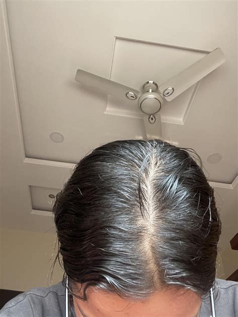 Does This Look Like Early Stage Of Androgenic Alopecia R Femalehairadvice