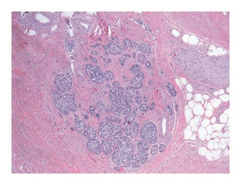 A Hande Sections Demonstrating Pancreatic Tissue With Dense Fibrosis