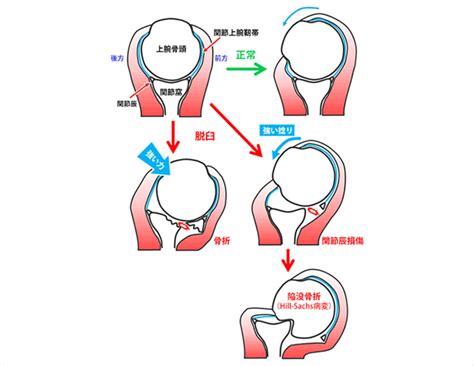 反復性肩関節脱臼（はんぷくせいかたかんせつだっきゅう） 診療科・診療センター 名鉄病院