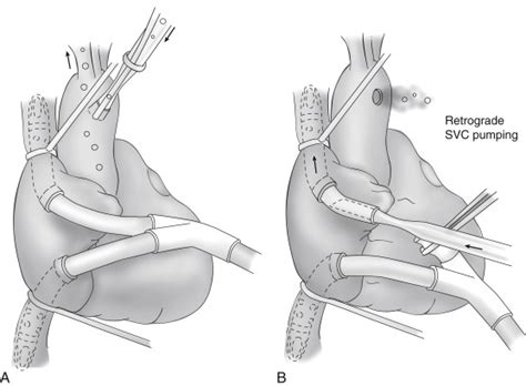 Troubleshooting Common Problems During Cardiopulmonary Bypass | Anesthesia Key