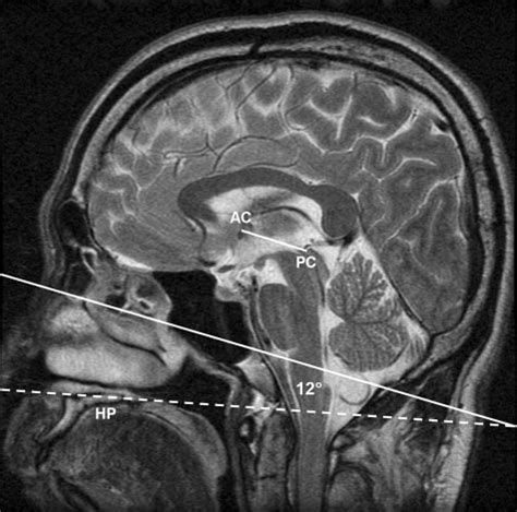 Midline Roll And Yaw Corrected Sagittal Fast Spin Echo T Weighted Mr