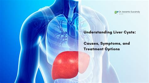 Ppt Understanding Liver Cysts Causes Symptoms And Treatment Option Powerpoint Presentation