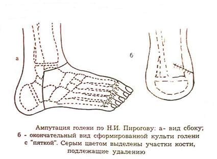 Ампутация стопы