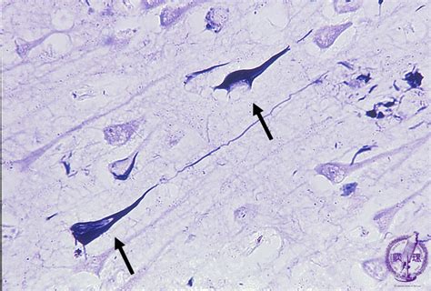 17 Nervous System 4 Alzheimer Type Dementia Pathology Core Pictures