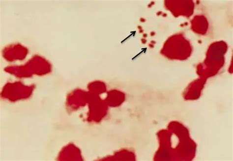 Neisseria Meningitidis Properties Pathogenesis Lab Diagnosis