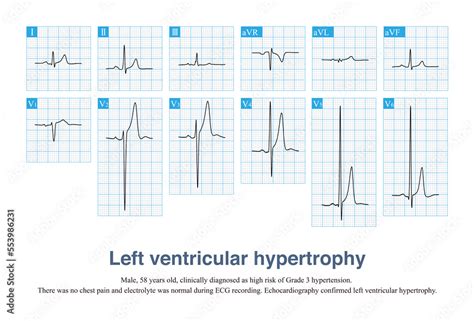 Sometimes, left ventricular hypertrophy with tall T waves is easily ...