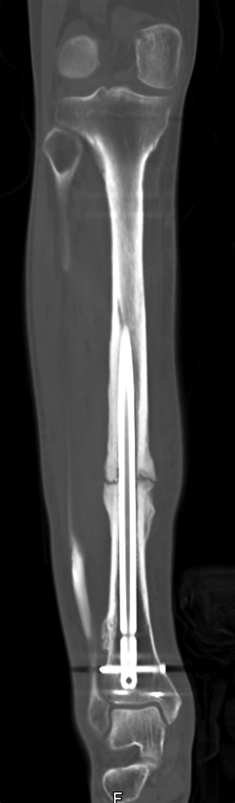 Value Of 3D CT In Defining Skeletal Complications Of Orthopedic