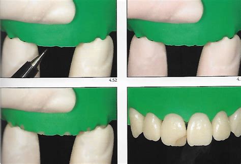 Rubber Dam Isolation Of The Anterior Segment Dental Esthetics