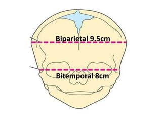 maternal pelvis  fetal skull