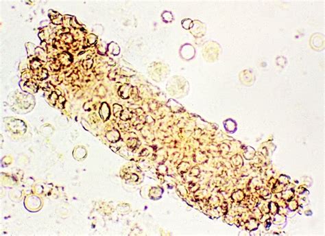 Red Blood Cells Casts In Renal Hematuria Medical Laboratories