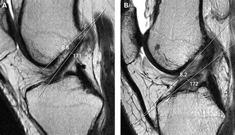 The ABCs Of The Anterior Cruciate Ligament A Primer For Magnetic