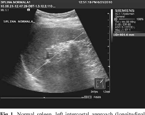 Normal Spleen Ultrasound