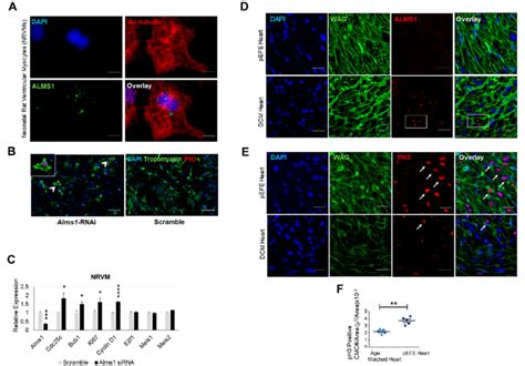 The Novel Alms1 Variant Abolishes Alms1 Protein Expression And Induces