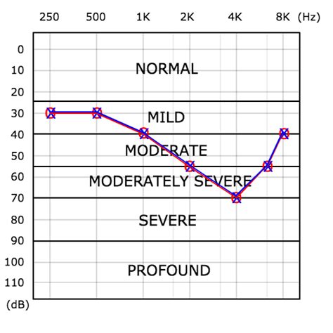 Audiogram How To Read A Hearing Test Pro Fit Hearing