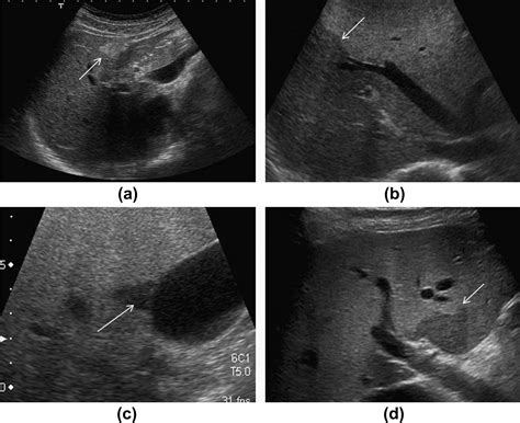 The Varied Sonographic Appearances Of Focal Fatty Liver Disease Review