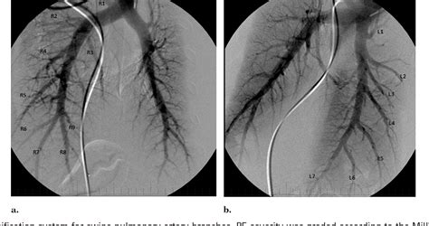 Lateral caval lymph node | Semantic Scholar