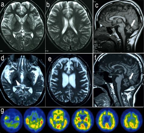 Magnetic Resonance Imaging MRI And Tc99m ECD Single Photon Emission