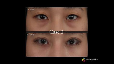 Transconjunctival Blepharoplasty Using Changs Needle Youtube