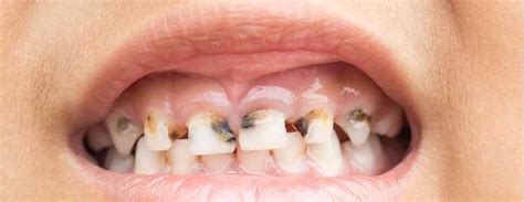 Introducing Images Of Rotten Teeth On Fizzy Drinks Could Encourage