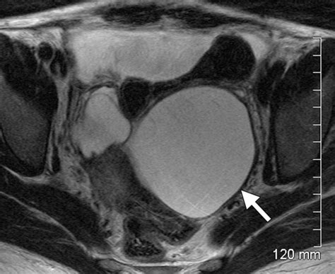 Uncommon Primary Pelvic Retroperitoneal Masses In Adults A Pattern Based Imaging Approach