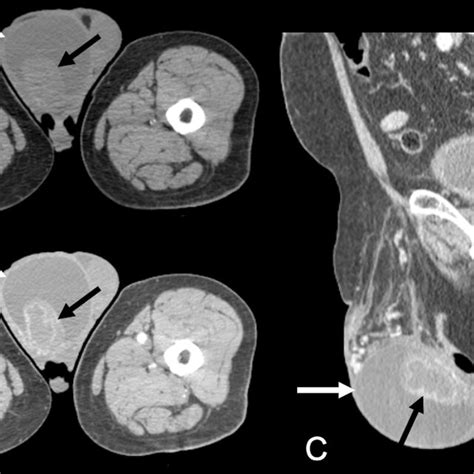 Pelvic Computed Tomography In The Axial A And B And Sagittal C