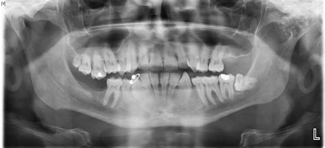 Synovial Chondromatosis Of The Temporomandibular Joint A Case Report