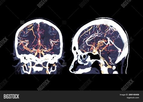 Ct Angiography Of The Brain Coronal And Sagittal View 3d Rendering