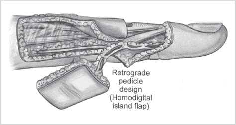 Design Of A Reverse Homodigital Artery Flap 1 Download Scientific Diagram