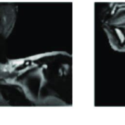 MRI of thyroid of the same patient, showing non-enhanced T2-weighted ...