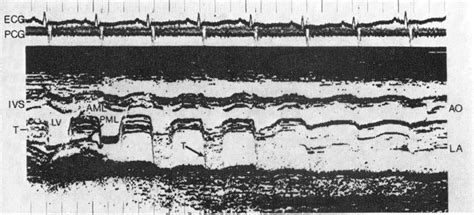 Echocardiogram And Phonocardiogram Pcg From Case A Sweep From Left