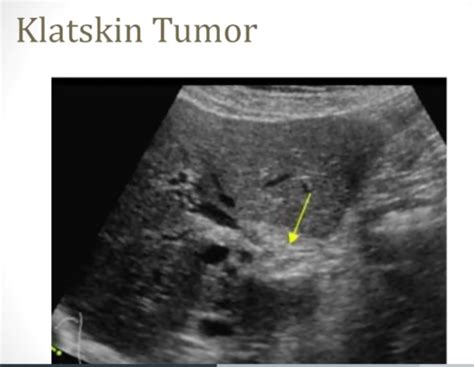 Klatskin Tumor Ultrasound