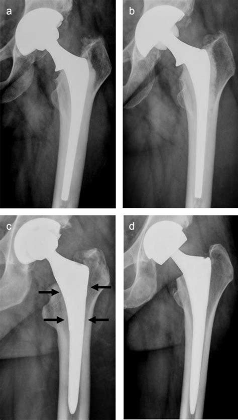 Imaging Of Hip Arthroplasty European Journal Of Radiology