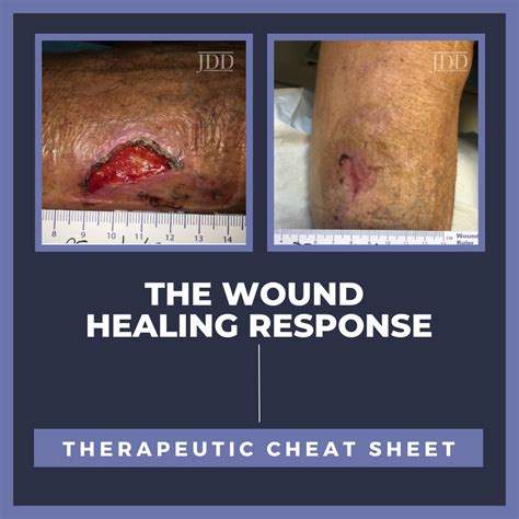 The Wound Healing Response Therapeutic Cheat Sheet Next Steps In