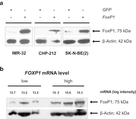 Inducible Expression Of Foxp In Neuroblastoma Cell Lines And