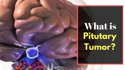 Pituitary Tumor Symptoms Causes Pictures Signs And Symptoms Of