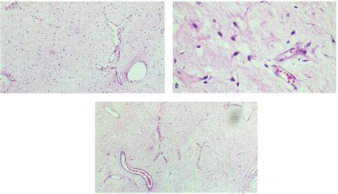 Microscopic Sections Show A Monotonous Hypocellular Neoplasm Composed