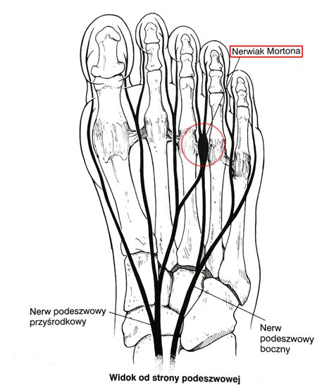 Nerwiak Mortona Objawy Przyczyny I Leczenie FizjoTerapia HD