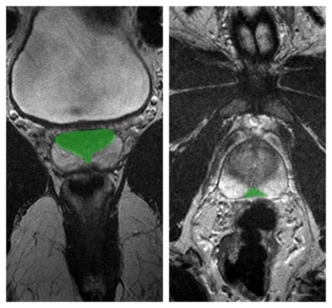 Prostate Gland Anatomy Mri