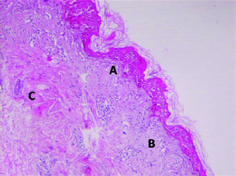 Full Thickness Epidermal Necrosis A Basal Vacuolar Changes B And