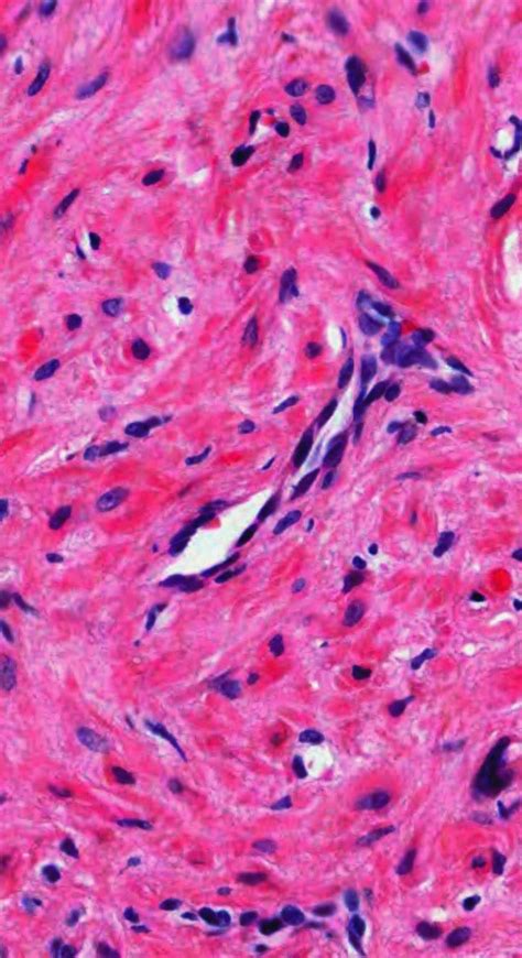 Pathology Of Angioleiomyoma Pathology Neuroma Thrombosis