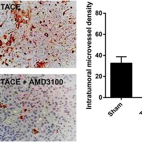 Amd Combined With Tace Regulates The Expression Of Hif And Vegf