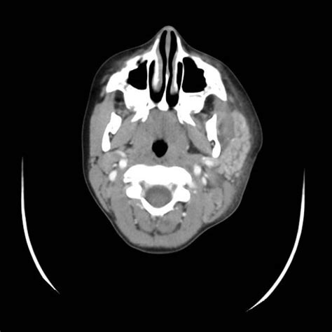 Parotitis