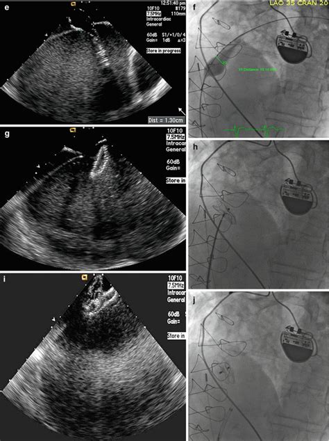 Intra Cardiac Echocardiography Guided Interventional Imaging