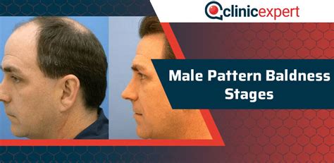 Male Pattern Baldness Stages Clinicexpert Healthcare