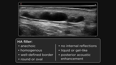 Ultrasound Characteristics Of Dermal Fillers Youtube