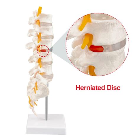 Ultrassist Modelo De Columna Vertebral Humana Con V Rtebras Lumbares