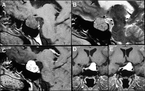 Primary Intrasellar Schwannoma Journal Of Clinical Neuroscience