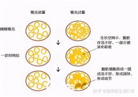 瘦腰腹做水动力吸脂和黄金微雕区别是 成效和价格上有不同 知乎